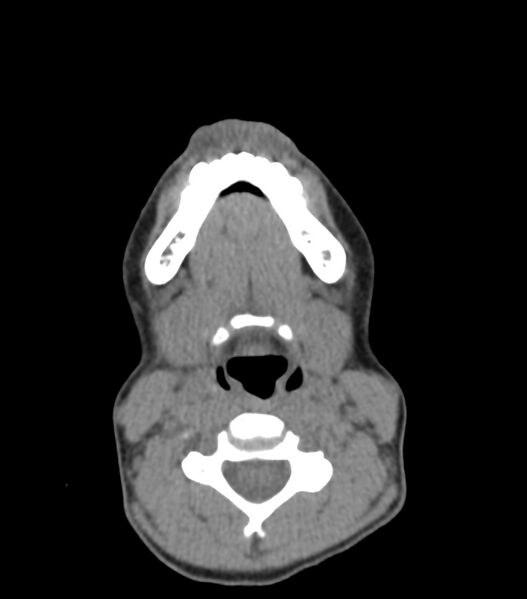 File:Nasoorbitoethmoid fracture (Radiopaedia 90044-107205 Axial non-contrast 47).jpg