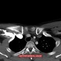 Nasopharyngeal carcinoma recurrence - skull base destruction (Radiopaedia 29107-29491 A 39).jpg