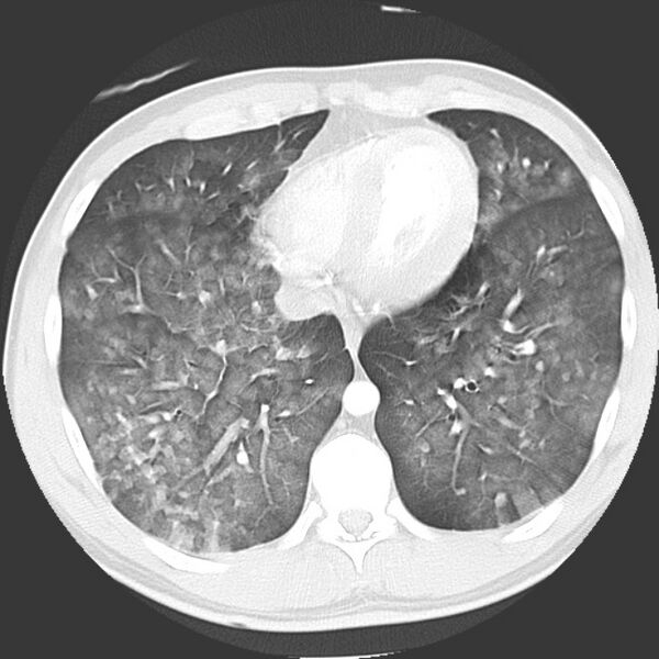 File:Near drowning pulmonary edema (Radiopaedia 16868-16591 Axial lung window 37).jpg