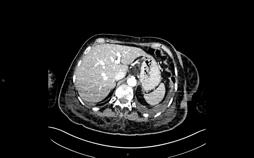 Neo-terminal ileal stricture (Crohn disease) (Radiopaedia 33790-34948 A 82).jpg