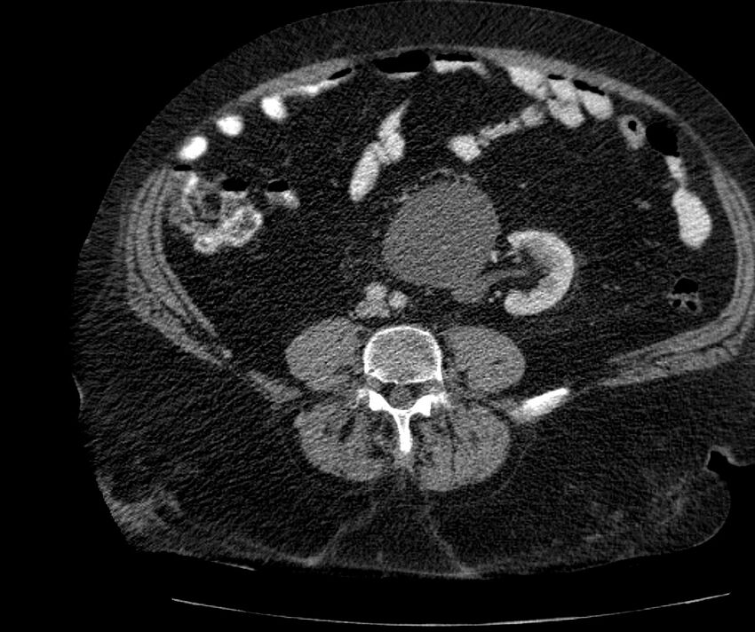 Nephroptosis with inguinal hernia containing perirenal fat (Radiopaedia 56632-63391 C 215).jpg