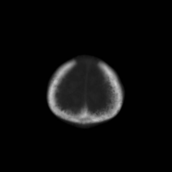 File:Neuroblastoma with skull metastases (Radiopaedia 30326-30958 Coronal bone window 5).jpg