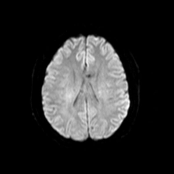 File:Neurofibromatosis type 2 (Radiopaedia 67470-76871 Axial DWI 13).jpg
