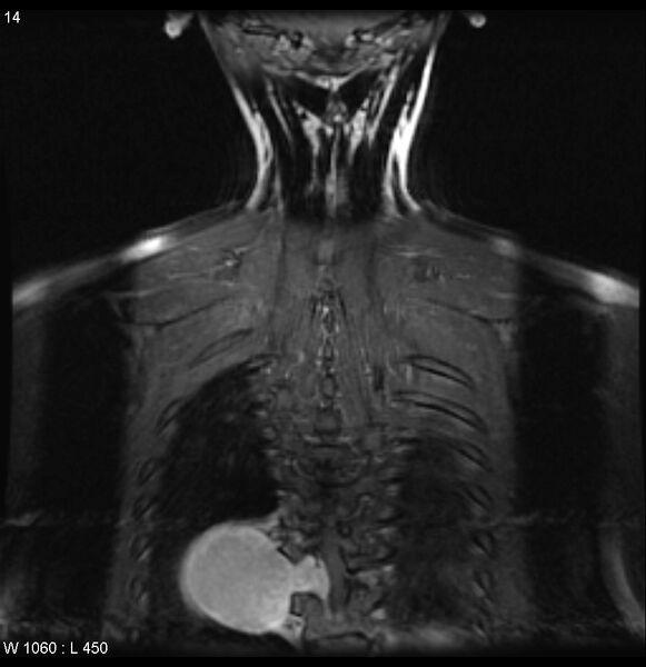 File:Neurofibromatosis type 2 - cranial and spinal involvement (Radiopaedia 5351-7112 E 4).jpg