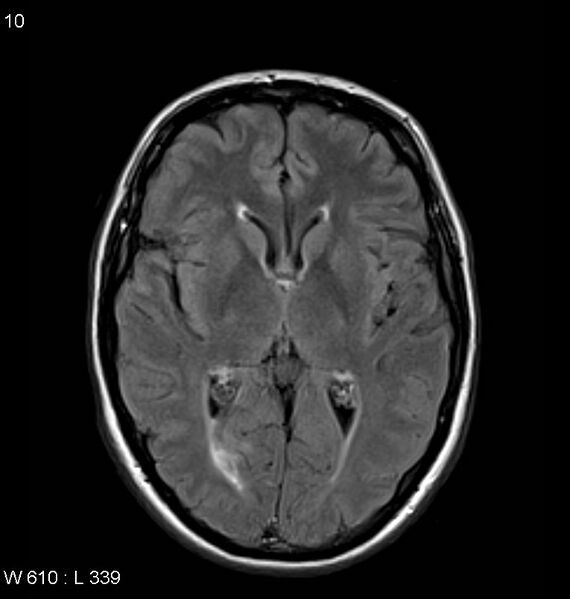 File:Neurosarcoidosis (Radiopaedia 10930-11351 Axial FLAIR 10).jpg
