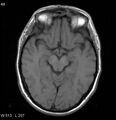 Neurosarcoidosis (Radiopaedia 10930-17204 Axial T1 8).jpg