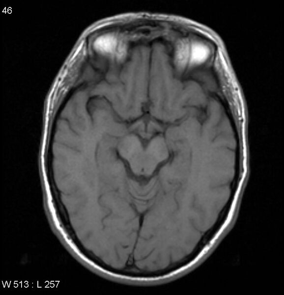 File:Neurosarcoidosis (Radiopaedia 10930-17204 Axial T1 8).jpg