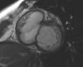 Non-compaction of the left ventricle (Radiopaedia 69436-79314 Short axis cine 173).jpg