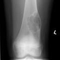 Non-ossifying fibroma - distal femur (Radiopaedia 8111-8946 Frontal 1).jpg