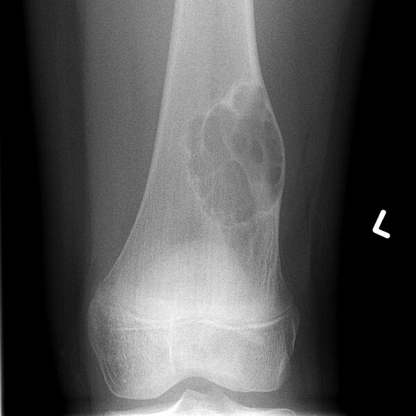 File:Non-ossifying fibroma - distal femur (Radiopaedia 8111-8946 Frontal 1).jpg