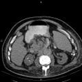 Non Hodgkin lymphoma in a patient with ankylosing spondylitis (Radiopaedia 84323-99621 Axial non-contrast 36).jpg