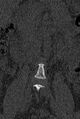 Normal CT lumbar spine (Radiopaedia 53981-60118 Coronal bone window 2).jpg