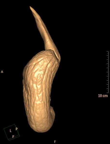 File:Normal CT virtual gastroscopy (Radiopaedia 29960-30501 3D VG 4).jpg