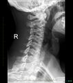 Normal cervical spine radiographs (Radiopaedia 32505-33464 Oblique 1).jpg
