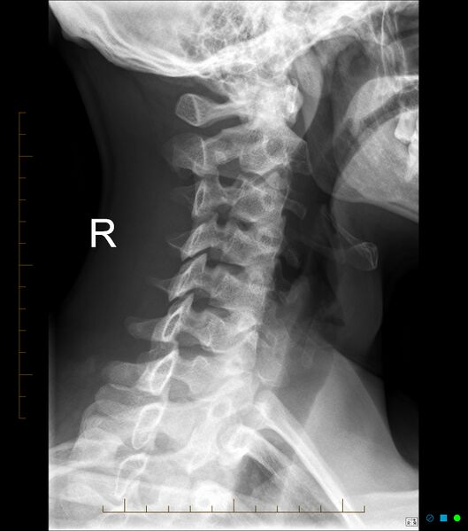 File:Normal cervical spine radiographs (Radiopaedia 32505-33464 Oblique 1).jpg