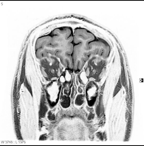File:Normal coronal brain (Radiopaedia 6676-7910 B 5).jpg