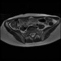 Normal female pelvis MRI (retroverted uterus) (Radiopaedia 61832-69933 Axial T2 6).jpg