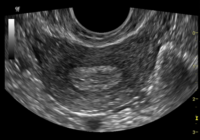 File:Normal pelvic ultrasound - transvaginal (Radiopaedia 31750-32684 Transverse 1).png