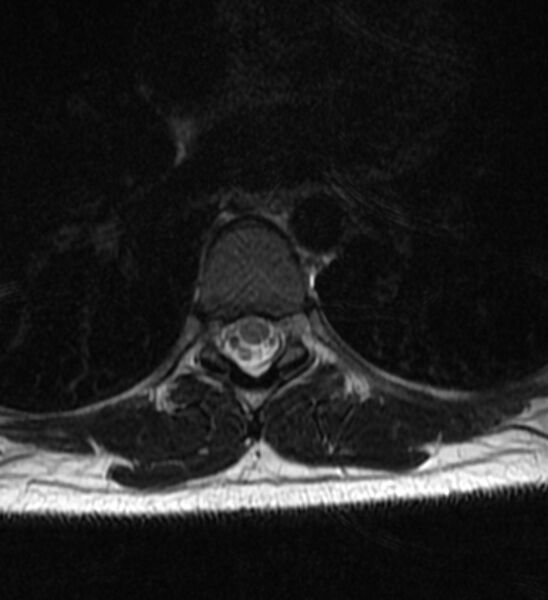 File:Normal thoracic spine MRI (Radiopaedia 41033-43781 Axial T2 2).jpg