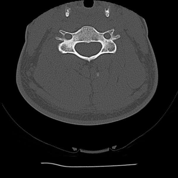 File:Normal trauma spine imaging (Radiopaedia 31753-32686 Axial bone window 47).jpg
