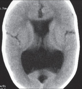 Image indicates colpocephaly with septal agenesis