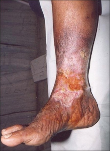 Chronic venous ulcer with malignant transformation