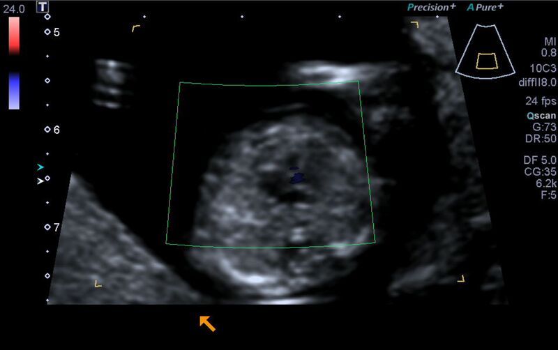 File:1st trimester nuchal-morphology ultrasound (Radiopaedia 44706-48477 Heart views cine with colour 110).jpg