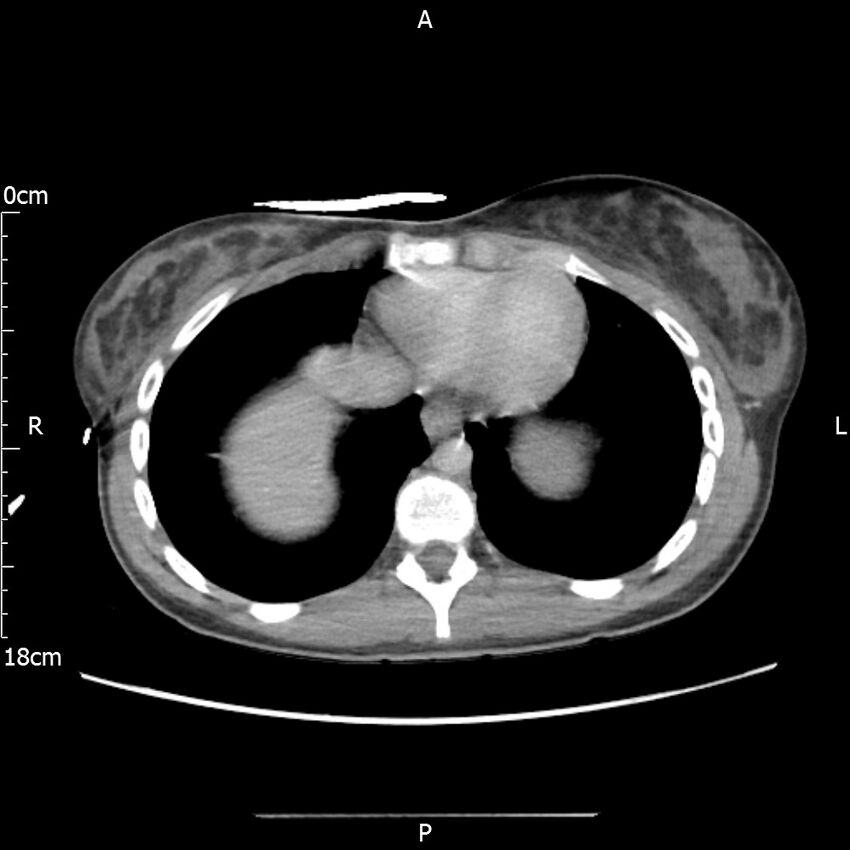 AAST grade IV kidney injury with CEUS follow-up (Radiopaedia 72353-82877 Axial C+ portal venous phase 4).jpg