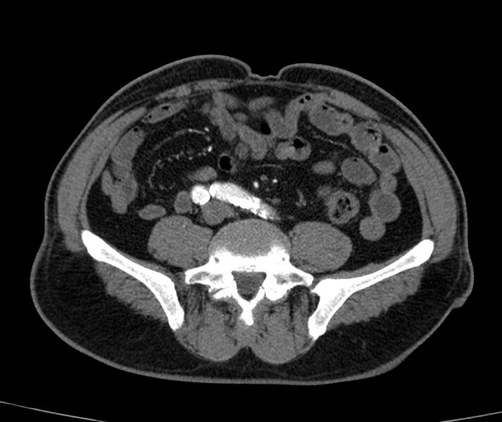 File:Abdominal aortic aneurysm (Radiopaedia 22421-22458 C+ arterial phase 62).jpg