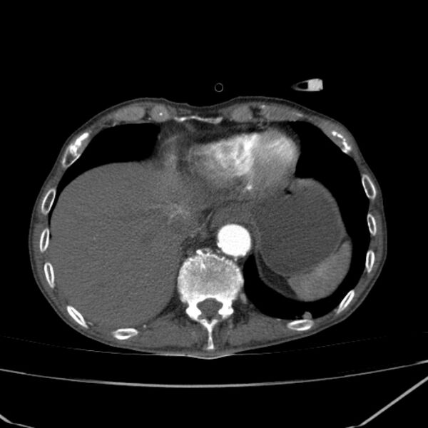 File:Abdominal aortic aneurysm (Radiopaedia 23703-23856 Axial C+ arterial phase 2).jpg