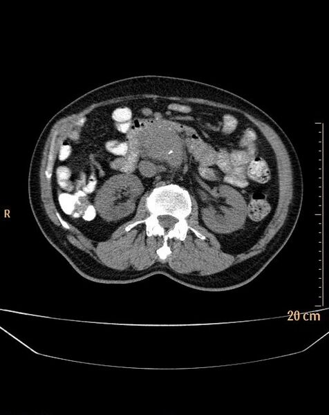 File:Abdominal aortic aneurysm (Radiopaedia 25985-26121 Axial non-contrast 8).jpg