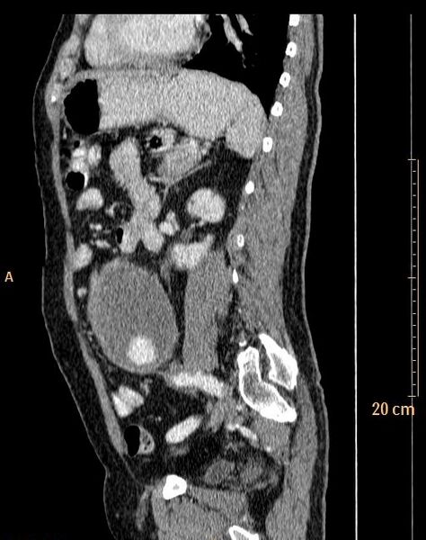 File:Abdominal aortic aneurysm (Radiopaedia 25985-26121 Sagittal C+ arterial phase 2).jpg