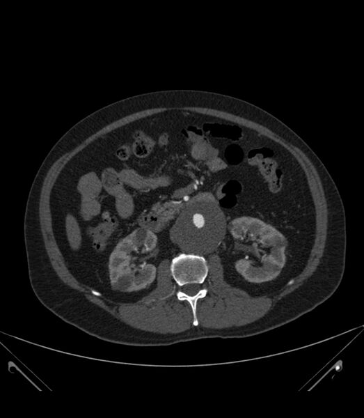 File:Abdominal aortic aneurysm with thrombus fissuration (Radiopaedia 46218-50618 Axial C+ arterial phase 17).jpg