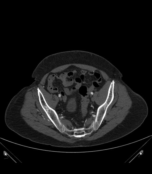 File:Abdominal aortic aneurysm with thrombus fissuration (Radiopaedia 46218-50618 Axial C+ arterial phase 36).jpg