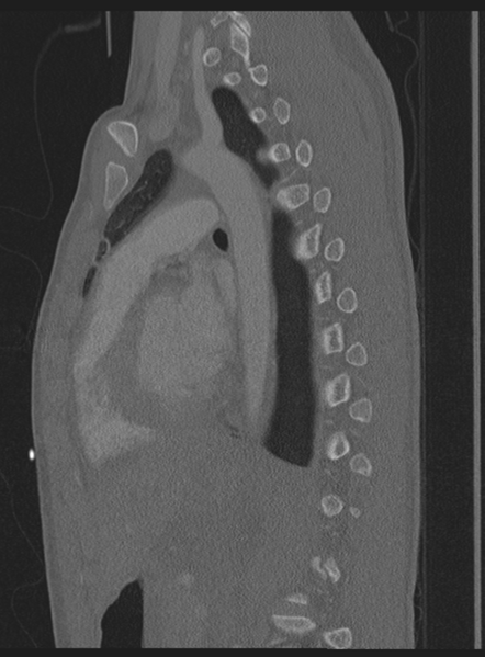 File:Abdominal multi-trauma - devascularised kidney and liver, spleen and pancreatic lacerations (Radiopaedia 34984-36486 Sagittal bone window 20).png