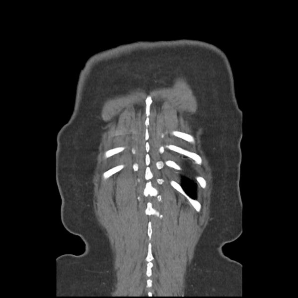 File:Aberrant right subclavian and left vertebral arteries (Radiopaedia 43467-46847 Coronal C+ portal venous phase 82).jpg