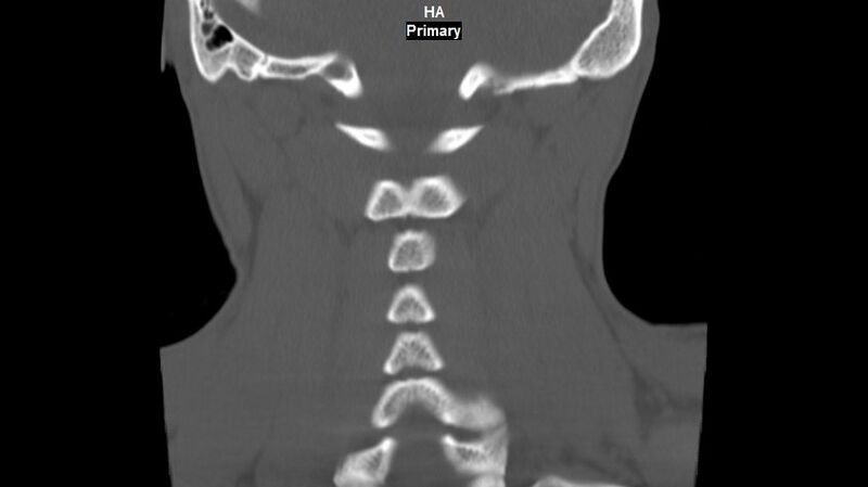 File:Accessory ossicle of the anterior arch of C1 vertebra (Radiopaedia 58149-65211 Coronal bone window 13).jpg