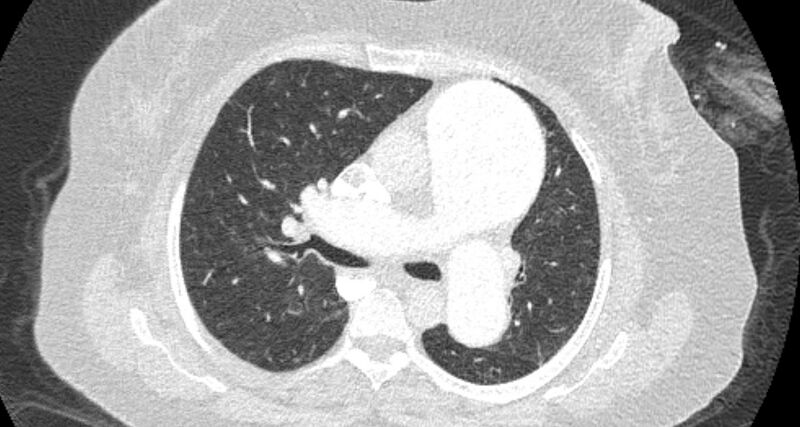 File:Accessory right inferior hepatic vein (Radiopaedia 65245-74259 Axial lung window 26).jpg