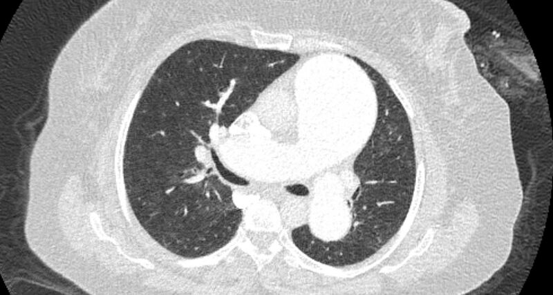 File:Accessory right inferior hepatic vein (Radiopaedia 65245-74259 Axial lung window 27).jpg