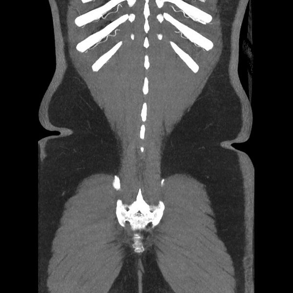 File:Active colonic bleed on CT (Radiopaedia 49765-55025 Coronal art MIP 55).jpg