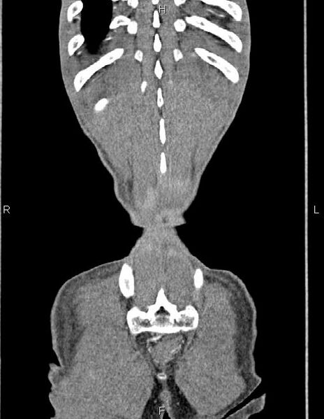 File:Active crohn disease (Radiopaedia 87133-103397 Coronal C+ arterial phase 63).jpg