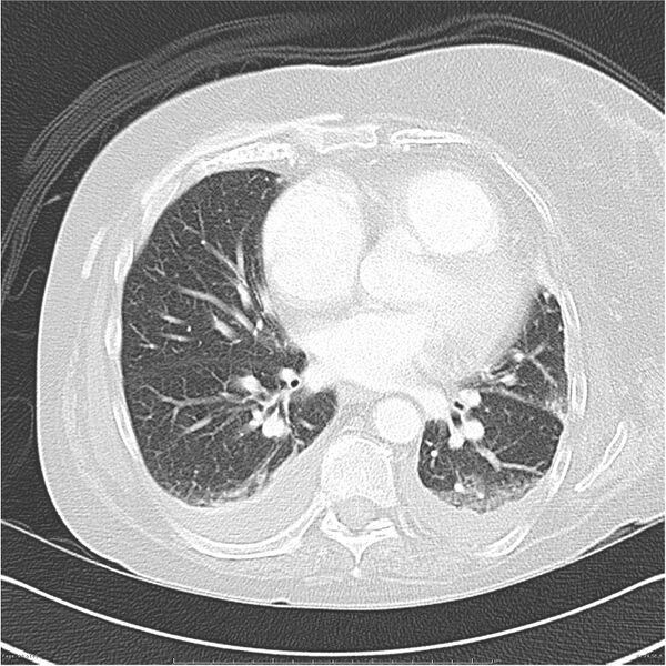 File:Acute-on-chronic pulmonary emboli (Radiopaedia 27925-28169 lung window 29).jpg