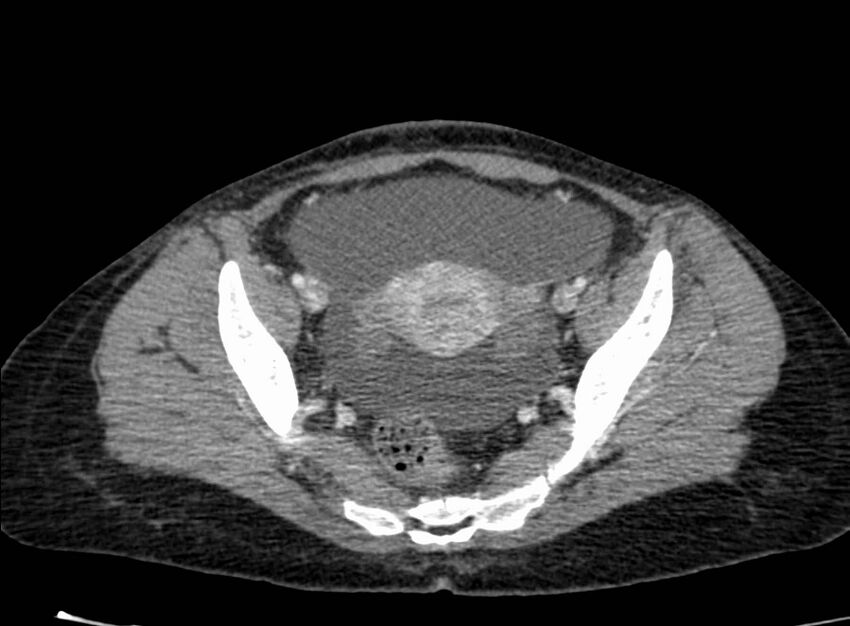 Acute Budd-Chiari syndrome (Radiopaedia 60858-68638 Axial C+ portal venous phase 254).jpg