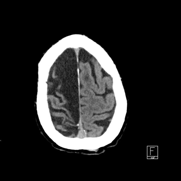 File:Acute ICA ischemic penumbra due to high-grade CCA stenosis (CT perfusion) (Radiopaedia 72038-82529 Axial non-contrast 41).jpg