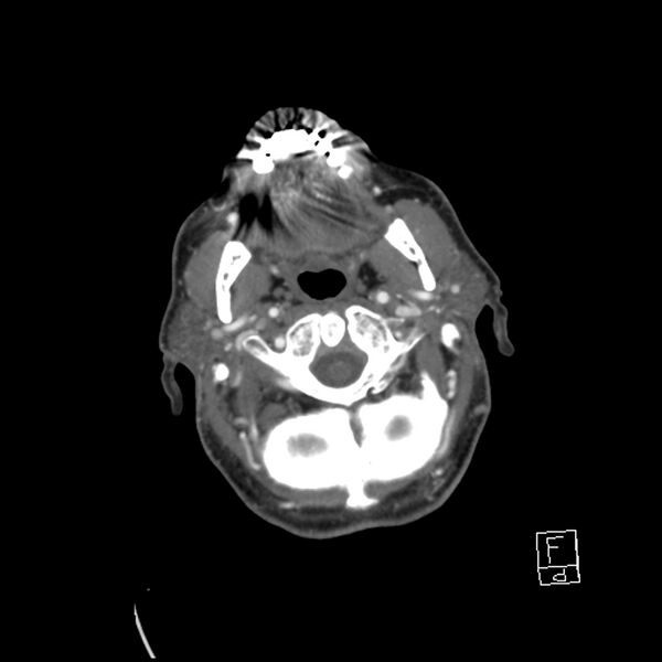 File:Acute ICA ischemic penumbra due to high-grade CCA stenosis (CT perfusion) (Radiopaedia 72038-82530 Axial C+ arterial phase 29).jpg