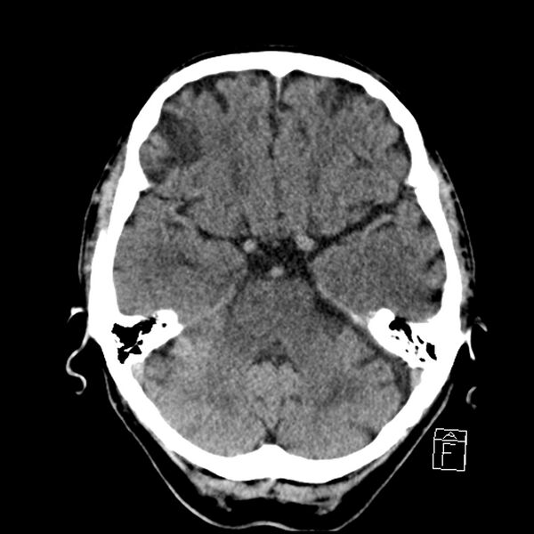 File:Acute P1 occlusion with PCA ischemia penumbra (CT perfusion) (Radiopaedia 72084-82586 Axial non-contrast 12).jpg