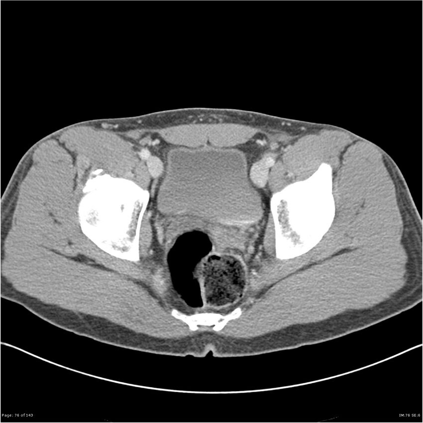 Acute appendicitis (Radiopaedia 25364-25615 B 66).jpg
