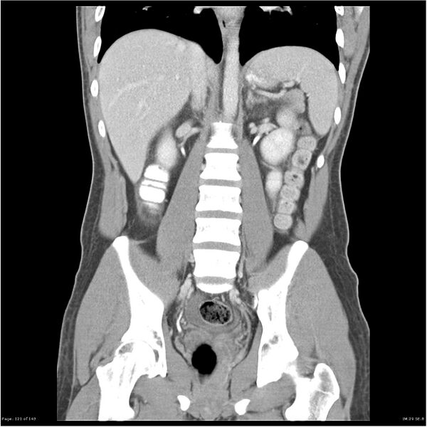 File:Acute appendicitis (Radiopaedia 25364-25615 C+ portal venous phase 18).jpg