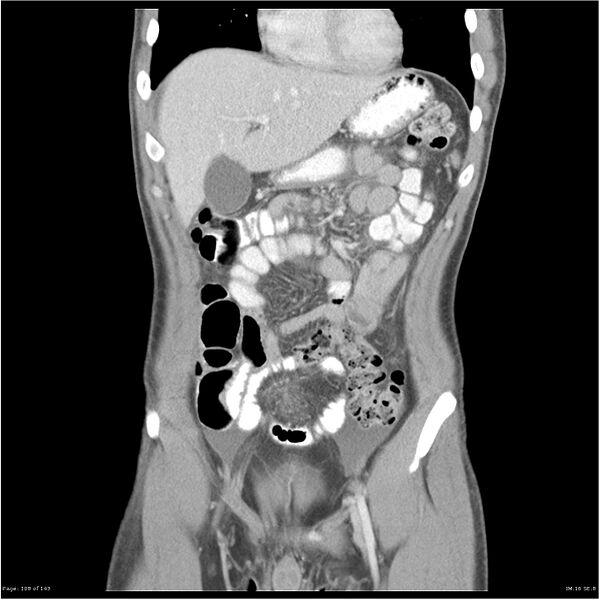 File:Acute appendicitis (Radiopaedia 25364-25615 C+ portal venous phase 5).jpg
