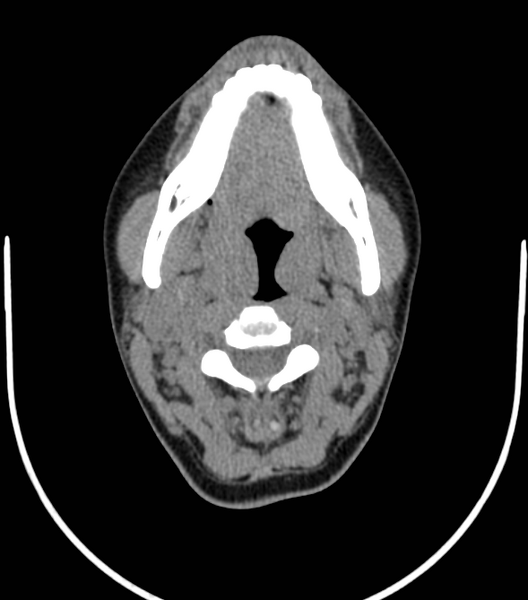 File:Acute bacterial tonsillitis (Radiopaedia 22882-22908 Axial non-contrast 21).png